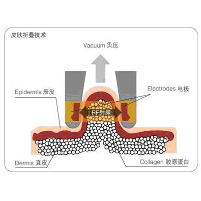 美容护肤吸脂器具_价格体雕仪Ⅱ代腾冲v吸脂开各种合金锡膏图片